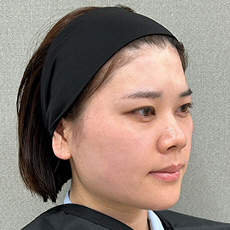 施術直後